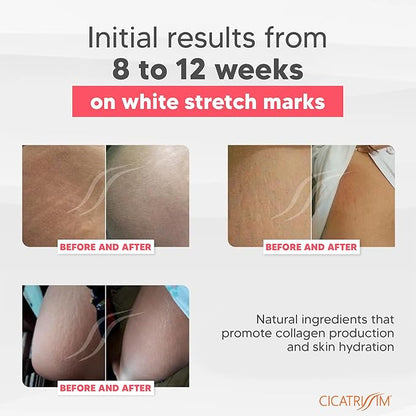 Cicatrissim White Stretch Mark Cream for White and Old Striae - Softens Stretch Marks, Evens Skin Tone, and Firms Skin - All Skin Types - 150g