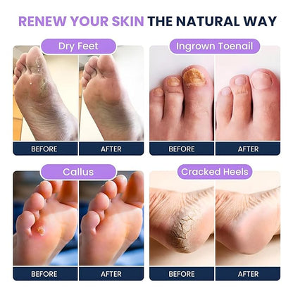 FOOT CURE Soothing Lavender Foot Soak - Pedicure Foot Spa with Epson Salts for Soaking Feet - Foot Massager Spa - Foot Scrubber Dead Skin Remover - Epsom Salt Bath Soak (Pack of 2)