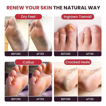 FOOT CURE Tea Tree Oil & Muscle Foot Soak with Epsom Salts - All-Natural Salts for Post-Workout Recovery - Softens Calluses, Soothes Sore & Tired Feet, Foot Odor Control, Spa Pedicure (Pack of 2)