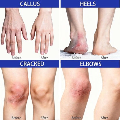 40% Urea Foot Cream with 2% Salicylic Acid, Urea Cream 40 Percent for Feet & Hands-Maximum Strength Moisturizer for Rough, Dry, Thick & Cracked Skin, Deep Hydration, Non-Greasy, 5.29 oz