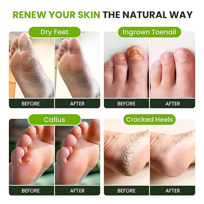 FOOT CURE Tea Tree Oil Foot Soak with Epsom Salts- for Foot Pain, Soreness, Athletes Foot, Odors, Toe Nail Fungus, Fungal, Calluses (Pack of 4)