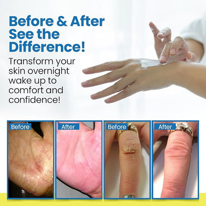 Dermasolve Full Body Eczema Relief Lotion Cream - Flare Control Therapy Balm That Protects, Moisturizes, and Repairs Skin Kids, Babies & Adults - Steroid Free (4 Fl Oz, 1)